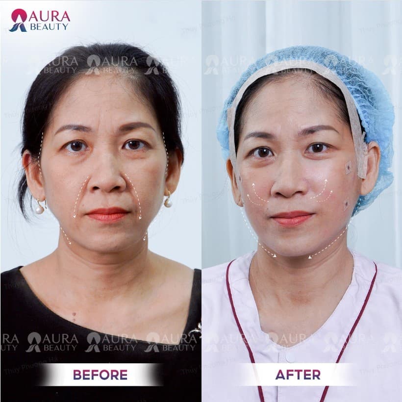 Siết cơ nội soi mang lại làn da tươi trẻ và căng mịn