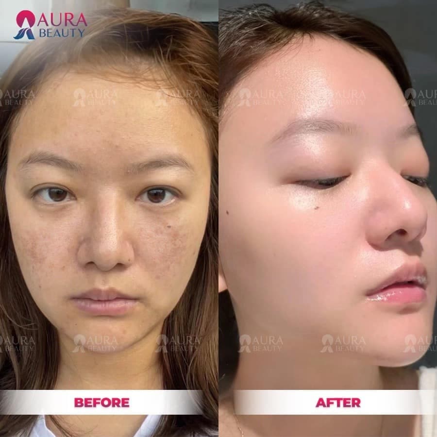 Khách hàng tiêm meso tại Thẩm mỹ viện Aura