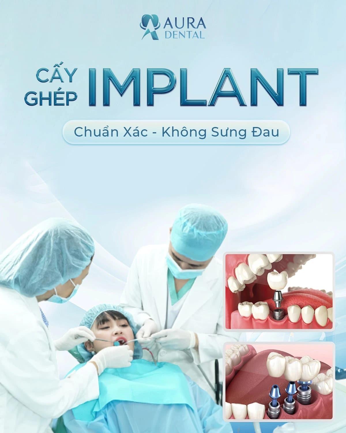 Cấy Ghép Implant