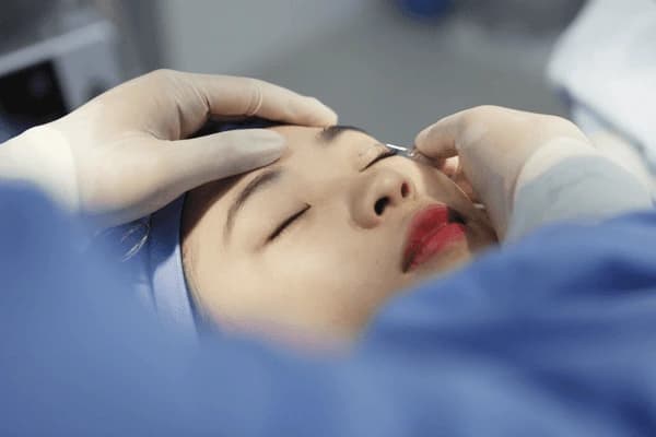Trường hợp cắt mí sau 1 tháng vẫn sưng có thể xuất phát từ lỗi kỹ thuật trong quá trình thực hiện