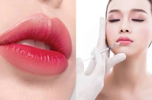 Các tiêu chí đánh giá an toàn khi tiêm filler môi