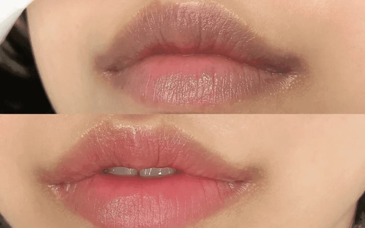 Môi thâm viền là tình trạng môi có màu viền sẫm và đen hơn