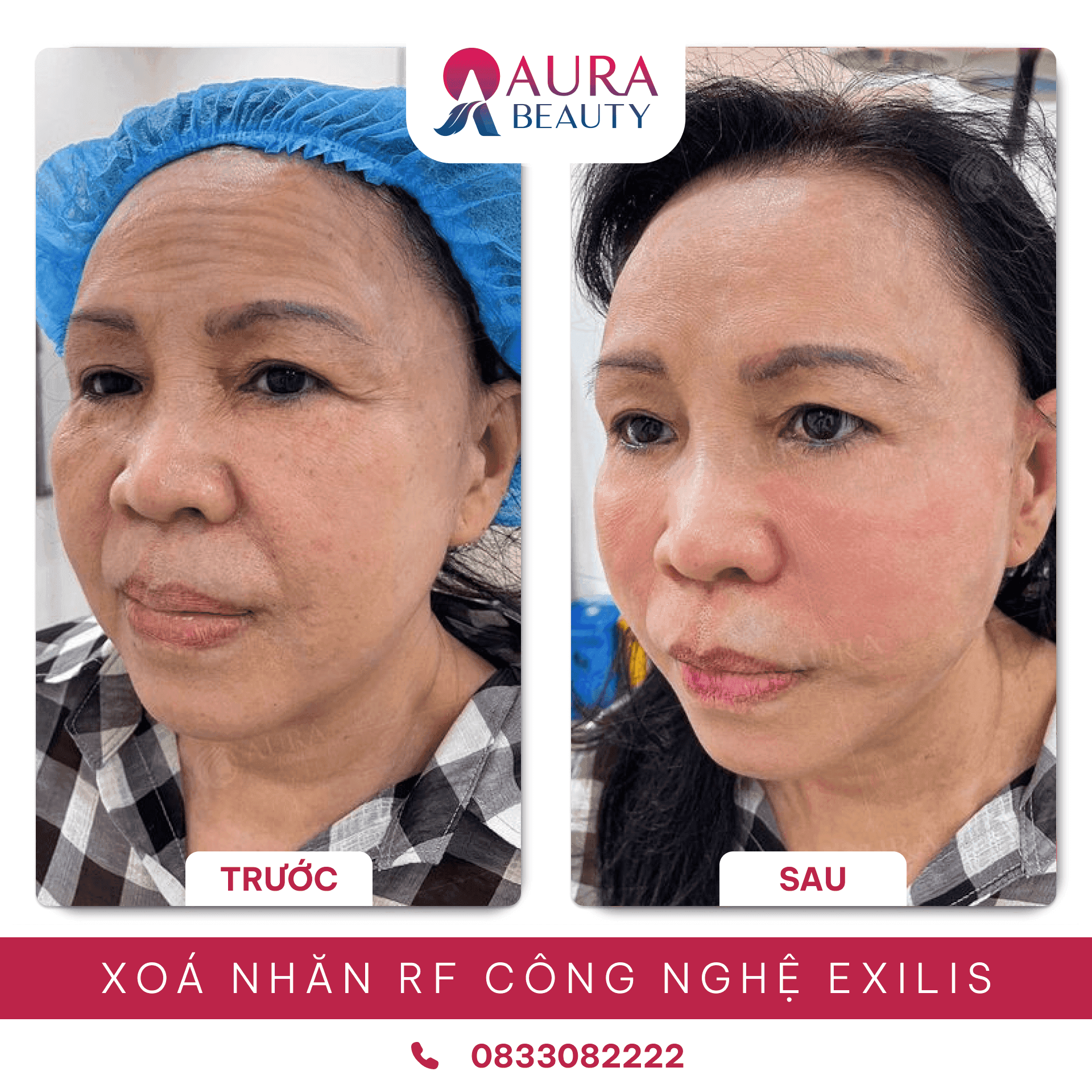 Xóa Nhăn RF Exilis