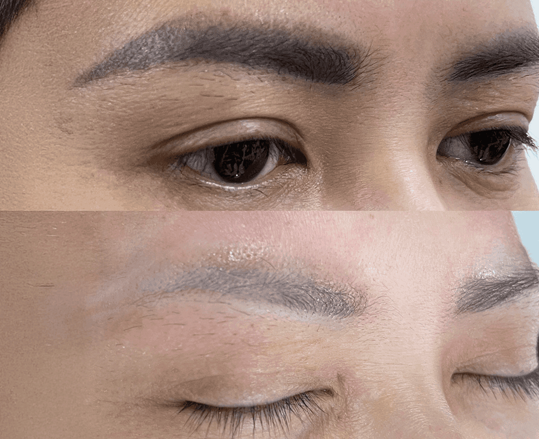 Xóa Xăm Công Nghệ Cao