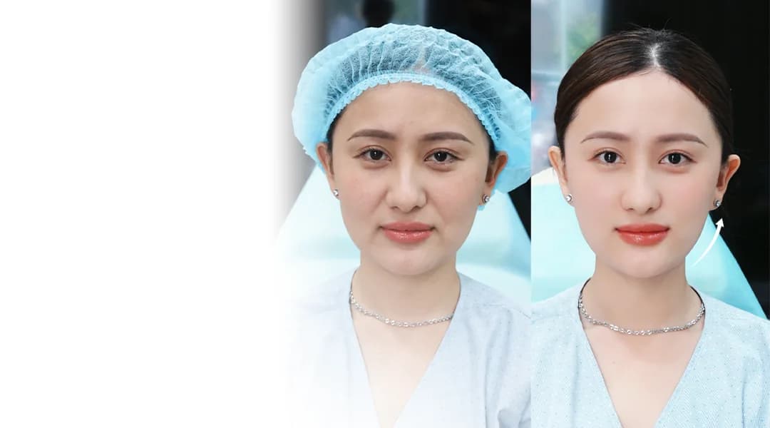 Khách hàng trước và sau liệu trình Airsculpt tại Aura Beauty: đường nét gương mặt gọn hơn