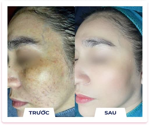 Kết quả điều trị nám thực tế 1