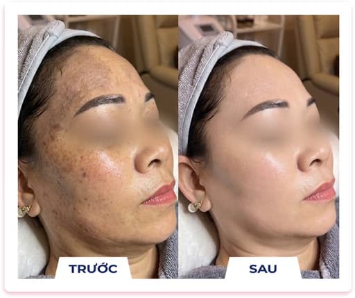 Kết quả điều trị nám thực tế 2