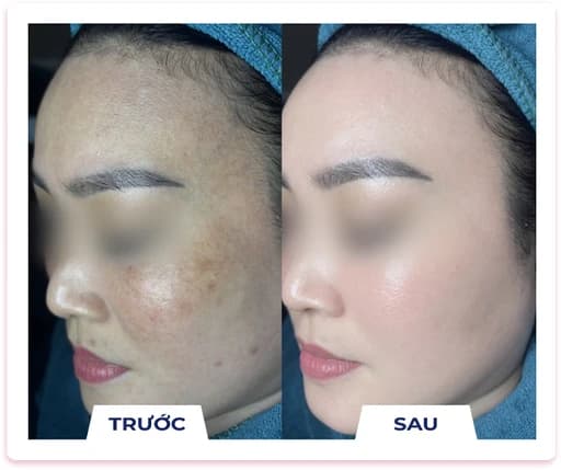 Kết quả điều trị nám thực tế 3