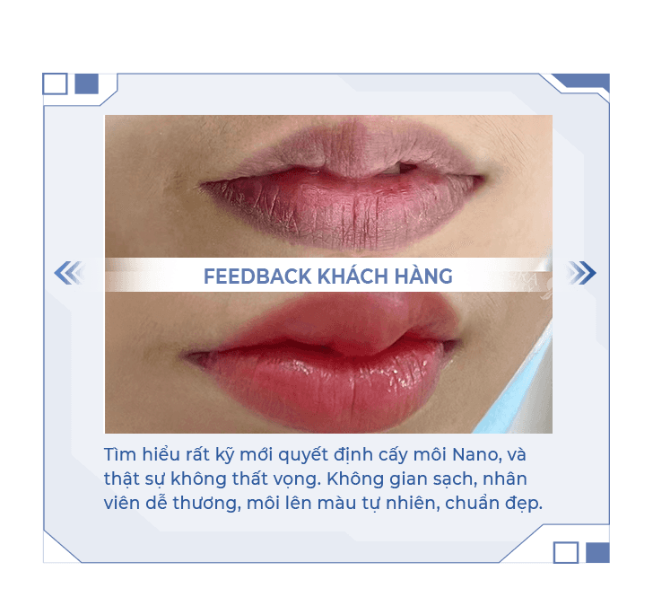 Cấy môi nano sinh học — Aura Beauty