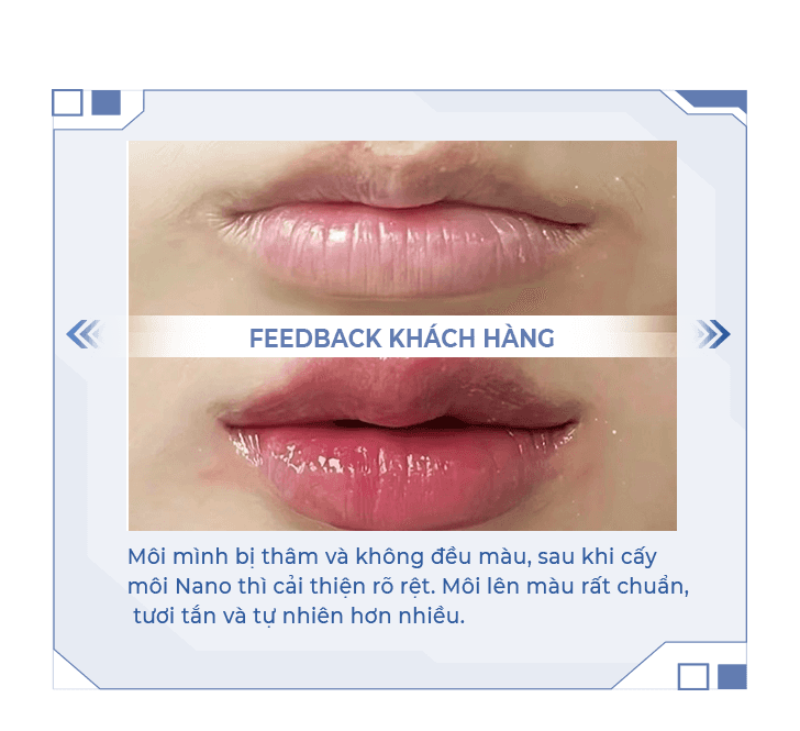 Cấy môi nano sinh học — Aura Beauty