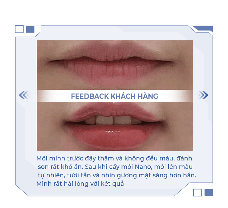 Cấy môi nano sinh học — Aura Beauty