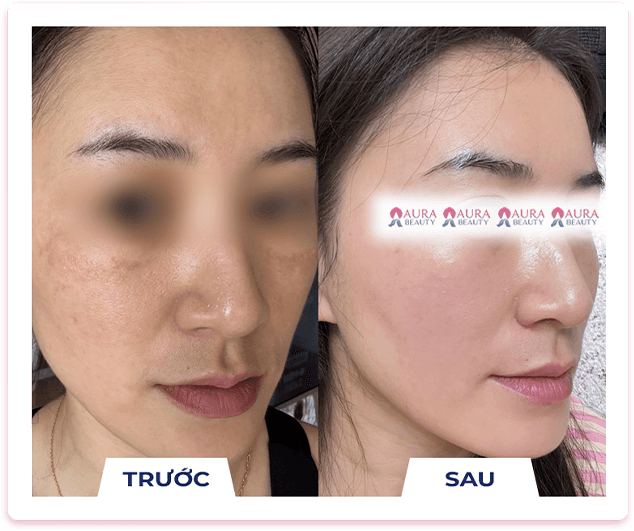 Skin Gold Therapy — Aura Beauty