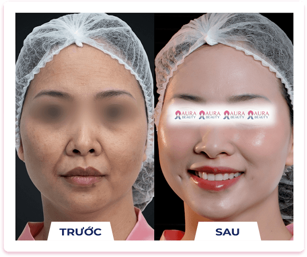 Skin Gold Therapy — Aura Beauty