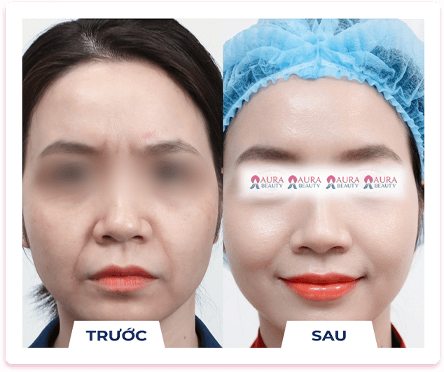 Skin Gold Therapy — Aura Beauty